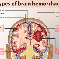 Epidural Hematoma vs Subdural Hematoma vs Subarachnoid Hemorrhage: Symptoms, Diagnosis, Treatment, and Prognosis