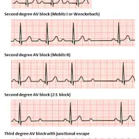 Heart Block: First Degree vs Second Degree (Type I and Type 2) vs Third Degree - ECG Findings, Symptoms, Diagnosis, Treatment, and Prognosis  [MCAT, USMLE, Biology, Medicine]