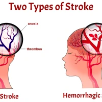 Types of Stroke - Ischemic Stroke vs Hemorrhagic Stroke: Symptoms, Diagnosis, Treatment, and Prognosis