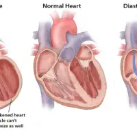Systolic Heart Failure vs Diastolic Heart Failure: Symptoms, Diagnosis, Treatment, and Prognosis  [MCAT, USMLE, Biology, Medicine]